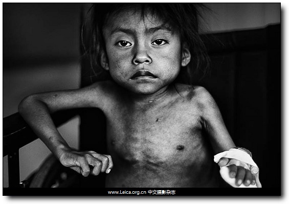 2011联合国儿童基金会年度图片奖危地马拉东部营养不良的孩童1.jpg
